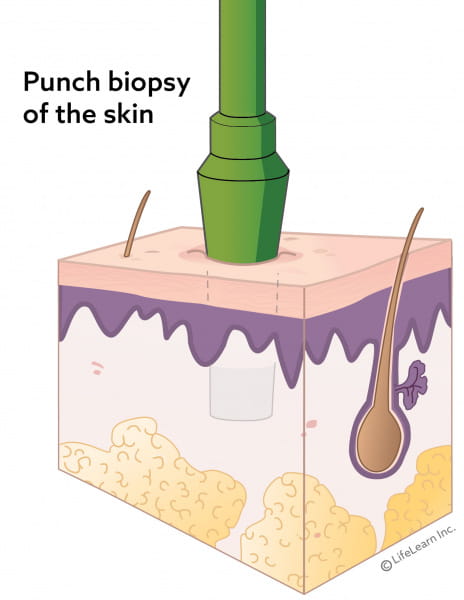 45+ Skin biopsy results abnormal