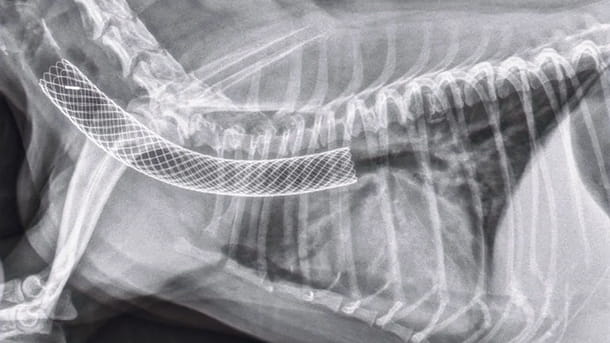 Tracheal stent