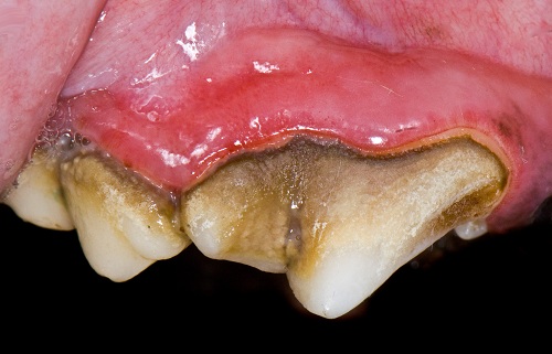 Gingivitis due to plaque on tartar
