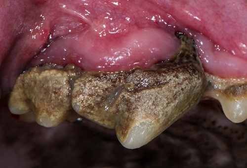 Periodontal disease due to progression of untreated gingivitis