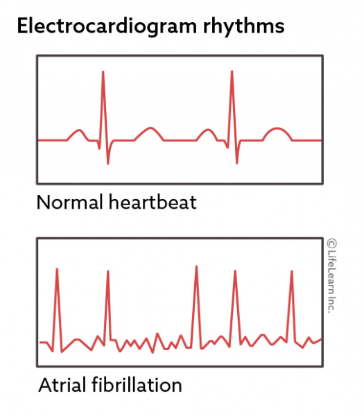 heart arrhythmia symptoms