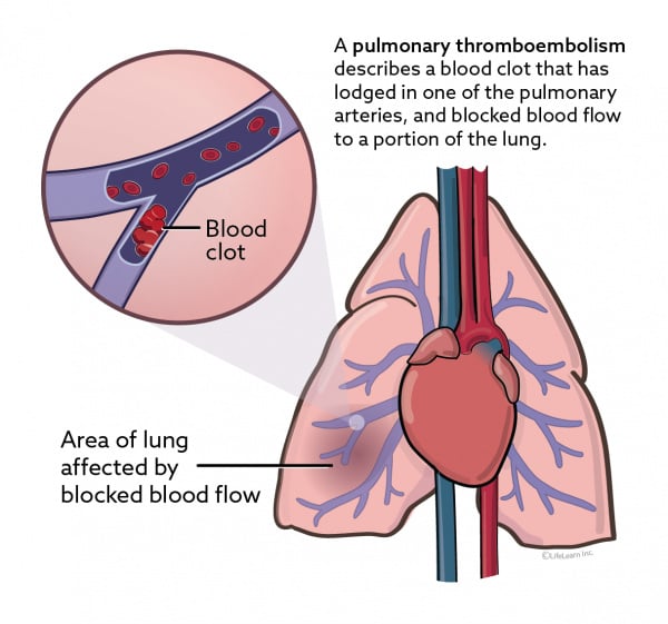 Pulmonary Thromboembolism (Blood Clots in the Lungs) in Dogs | VCA Animal  Hospital