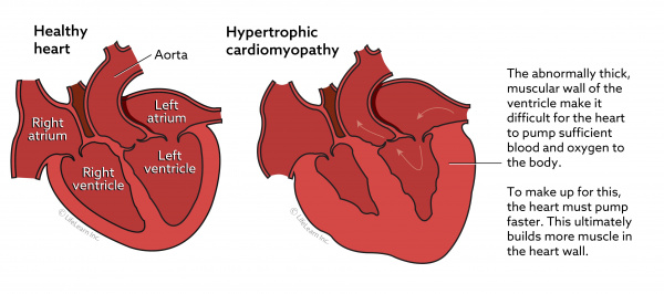 heart_disease_healthyheart_hypertrophic_cardiomyopathy