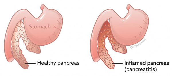 stomach_and_pancreas_pancreatitis_2017-01