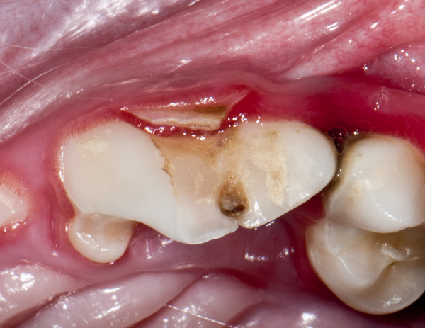 Slab fracture of the left upper fourth premolar