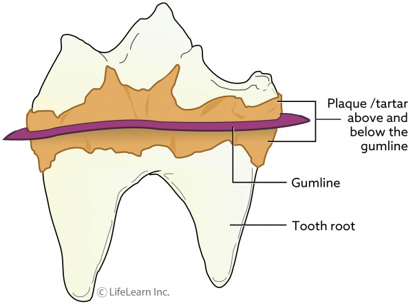 tooth-plaque_updated2017_2
