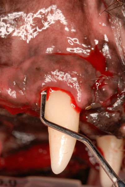 Gingivitis of the left upper fourth premolar
