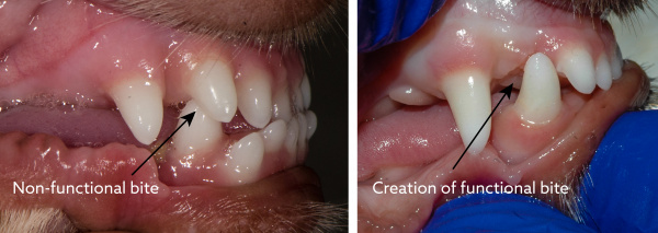Functional bite creation through incisor removal