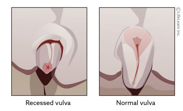 Pics vulva The Top
