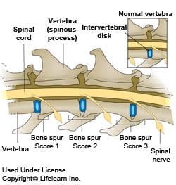 Spondylosis Deformans In Dogs Vca Animal Hospital