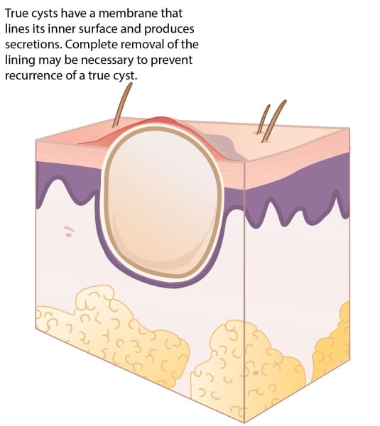 Sebaceous Cyst Life Cycle