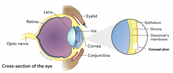 36 HQ Images Cat Eye Ulcer Removal : Conjunctival pedicle flap following removal of corneal ...