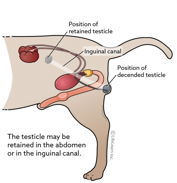 Retained Testicle (Cryptorchidism) in 