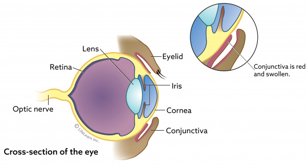 eye basic cross section w conjunctivitis 2020 01