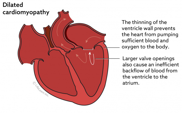 taurine deficient dilated cardiomyopathy