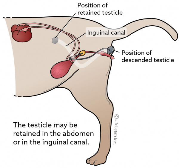 Retained Testicle (Cryptorchidism) in 