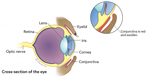 Chlamydial Conjunctivitis in Cats | VCA Animal Hospital